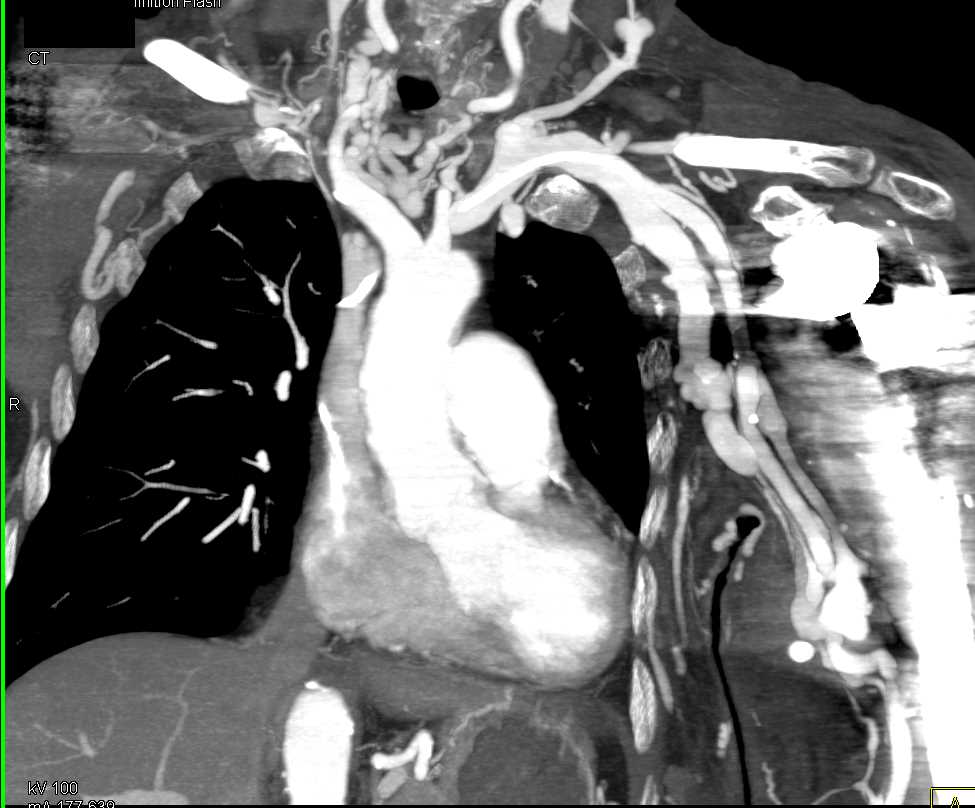AV Fistulae Left Arm with Collaterals - CTisus CT Scan