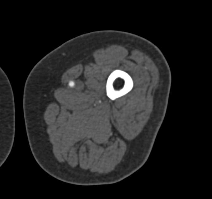 Multiple Clots in the Superficial Femoral Artery (SFA) and Popliteal artery - CTisus CT Scan