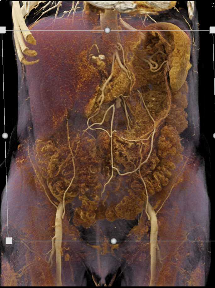 Superior Mesenteric Artery (SMA) Aneurysm - CTisus CT Scan