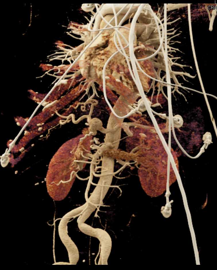 Hepatic Artery Aneurysm with CT Angiography and Cinematic Rendering - CTisus CT Scan