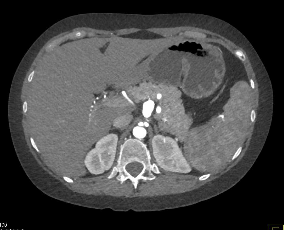 Multiple Vascular Aneurysms in Ehlers Danlos Syndrome - CTisus CT Scan