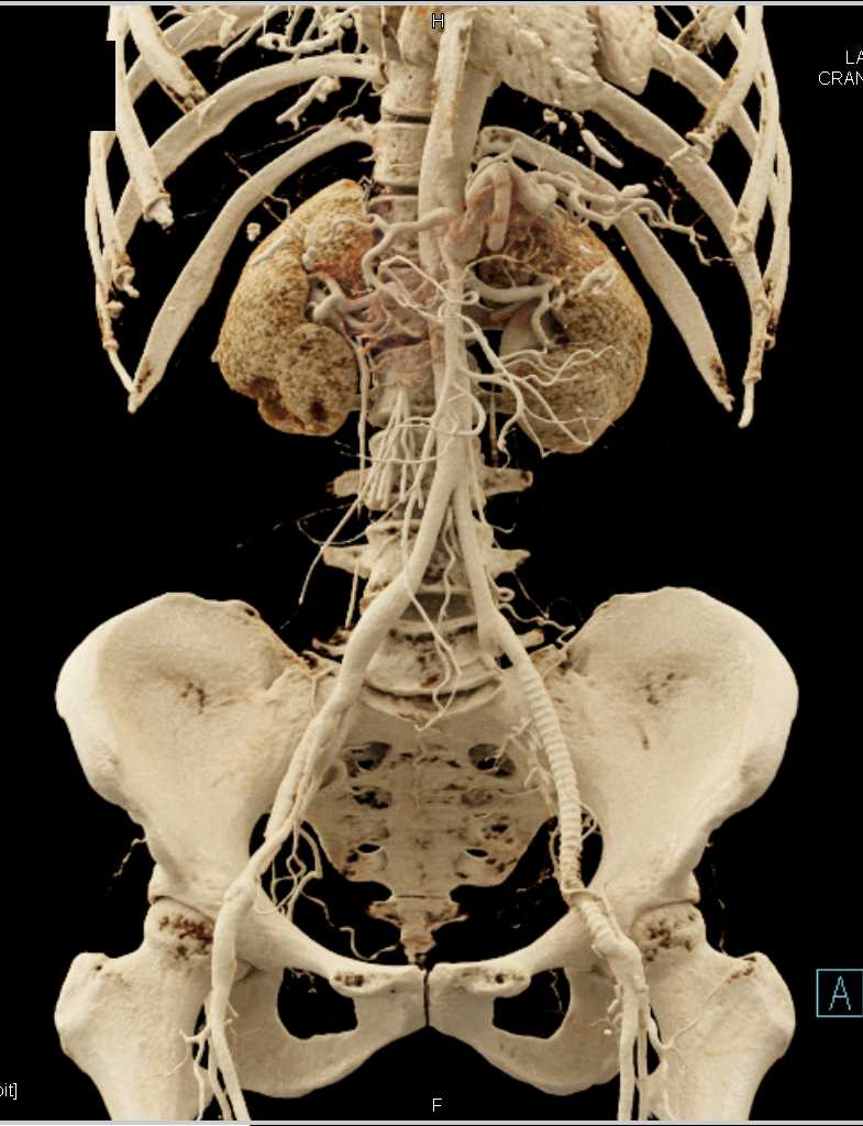 Cinematic Rendering of Vasculature Including Stents - CTisus CT Scan