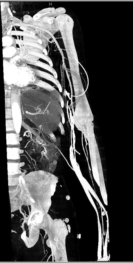 Trauma with Patent Brachial Artery - CTisus CT Scan