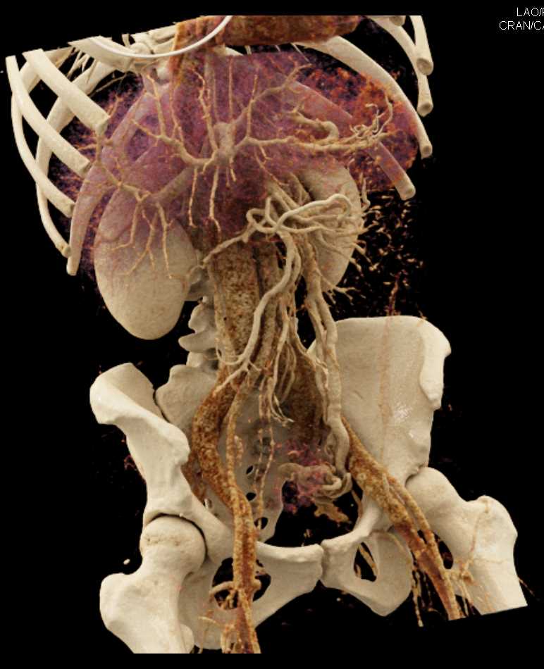 Prominent Left Pelvic Congestion Syndrome - CTisus CT Scan