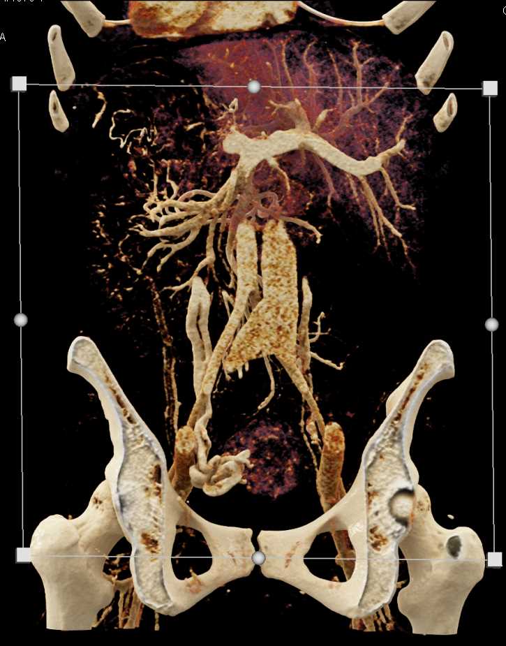 Prominent Gonadal Veins as Collaterals - CTisus CT Scan
