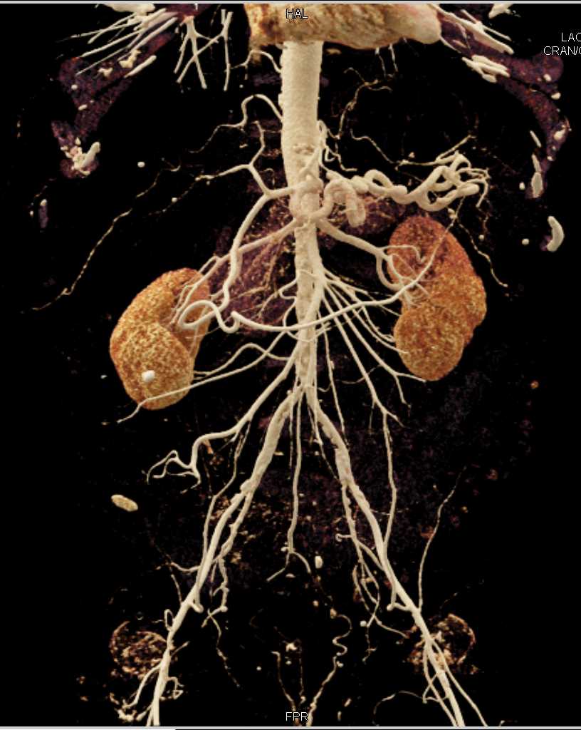 Diminished Caliber Iliac Arteries - CTisus CT Scan
