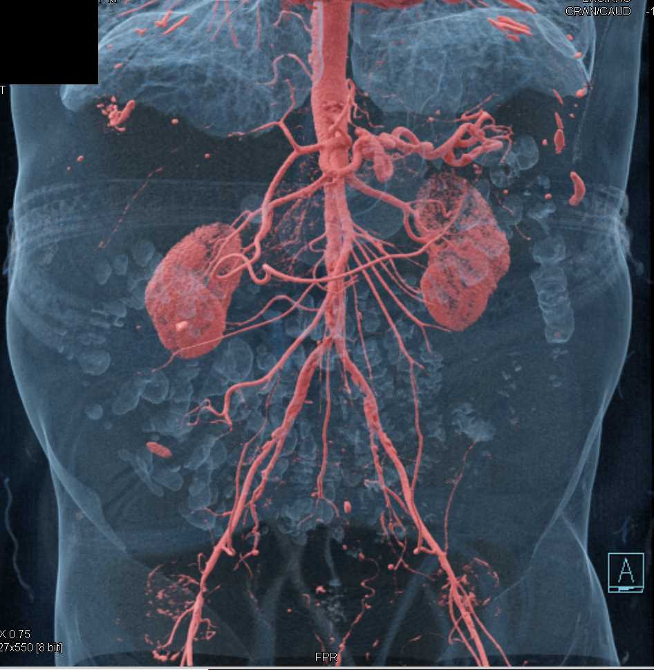 Diminished Caliber Iliac Arteries with Extensive Disease Shown With Cinematic Rendering - CTisus CT Scan