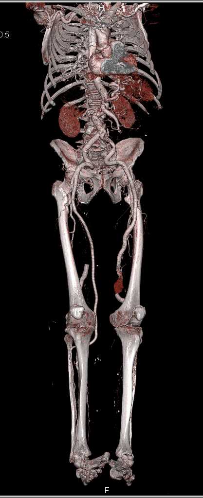 Peripheral Vascular Disease (PVD) with Vascular Grafts - CTisus CT Scan