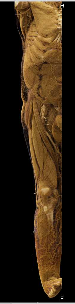 Peripheral Vascular Disease (PVD) with Vascular Grafts and Cinematic Rendering - CTisus CT Scan