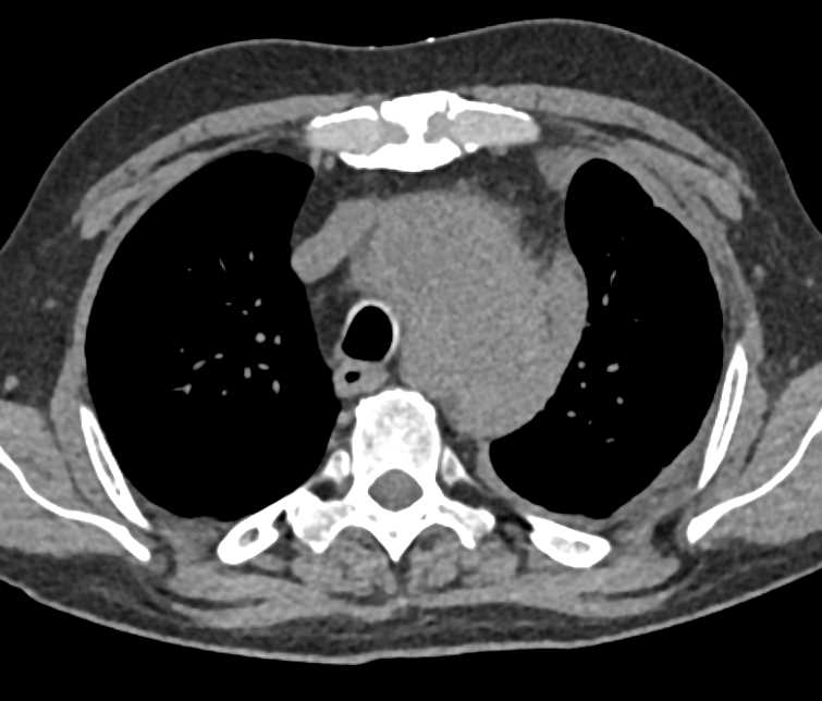 Erdheim Chester Disease - CTisus CT Scan