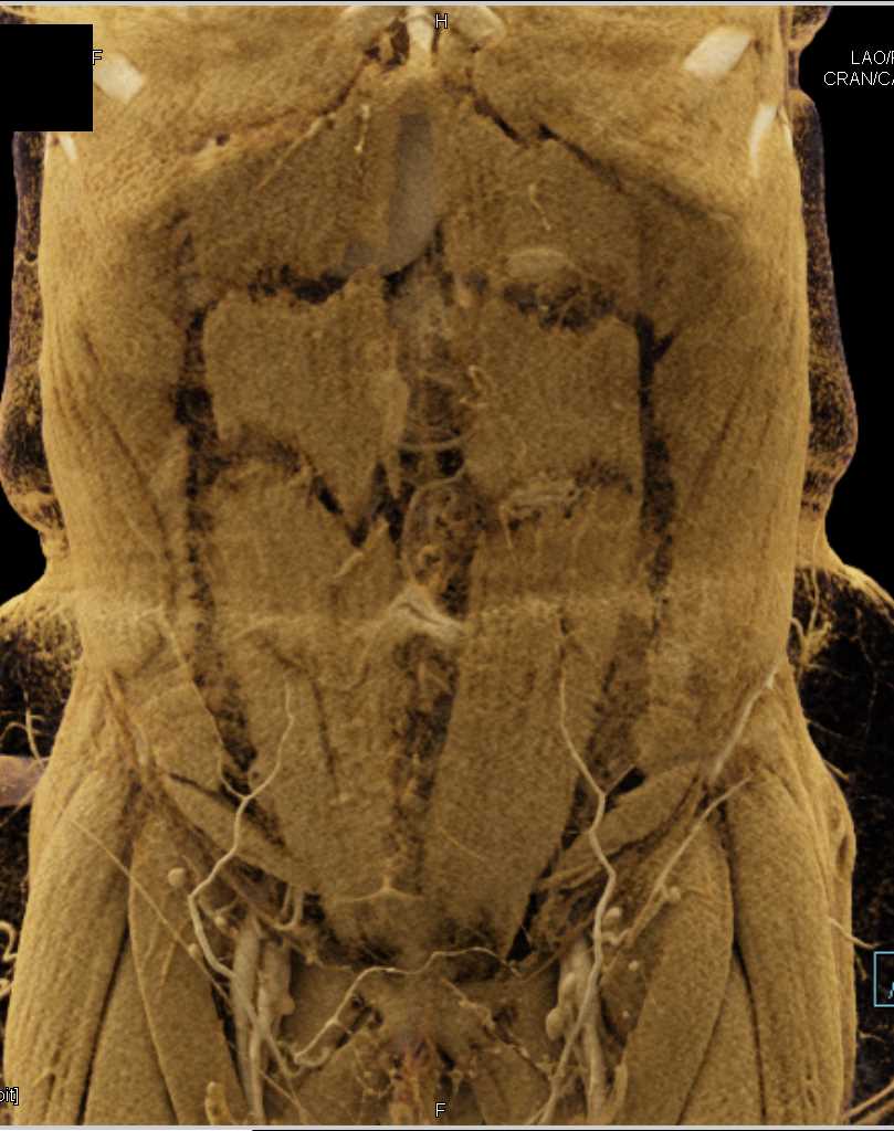 Mesenteric Arcade with Cinematic Rendering - CTisus CT Scan