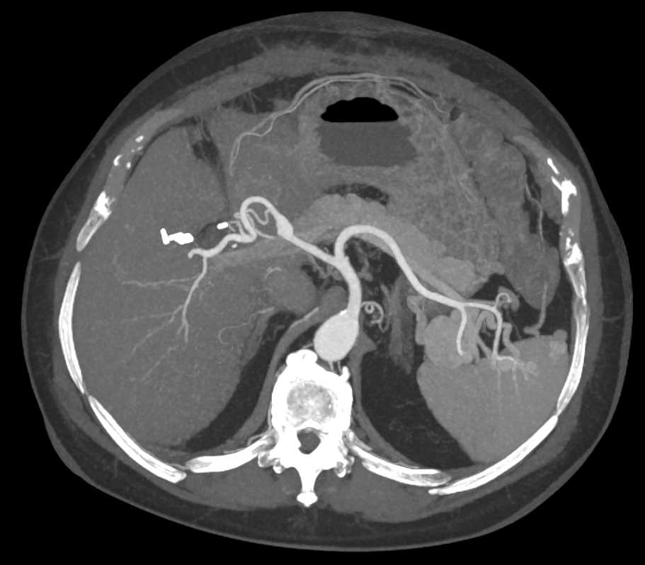 1cm Hepatic Artery Aneurysm - CTisus CT Scan