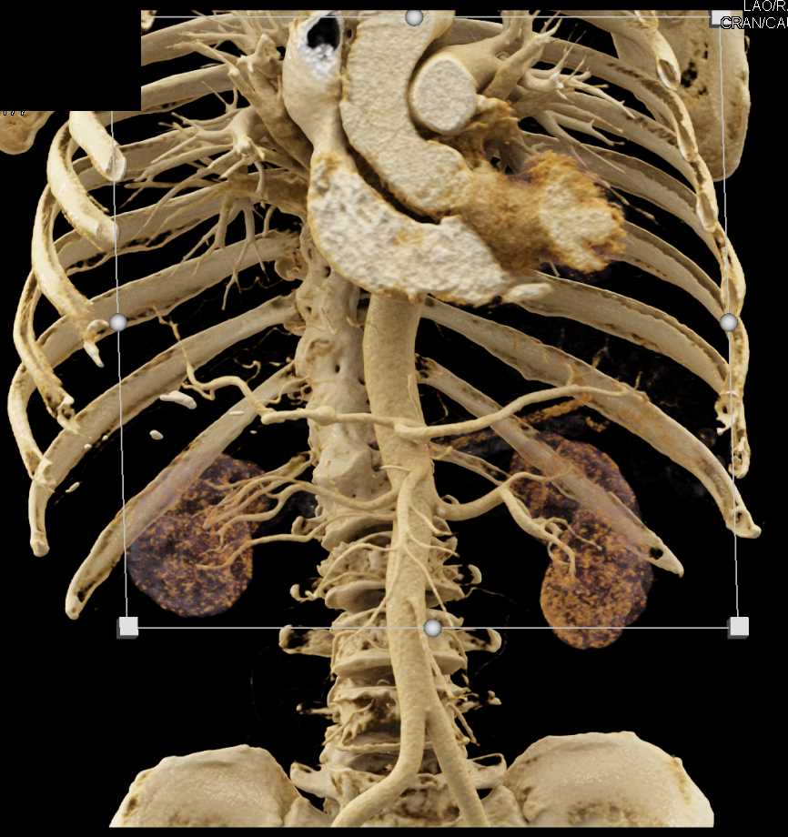 1cm Hepatic Artery Aneurysm - CTisus CT Scan