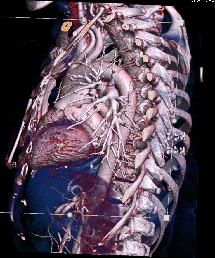 Vascular Mapping Thoracic Aorta - CTisus CT Scan