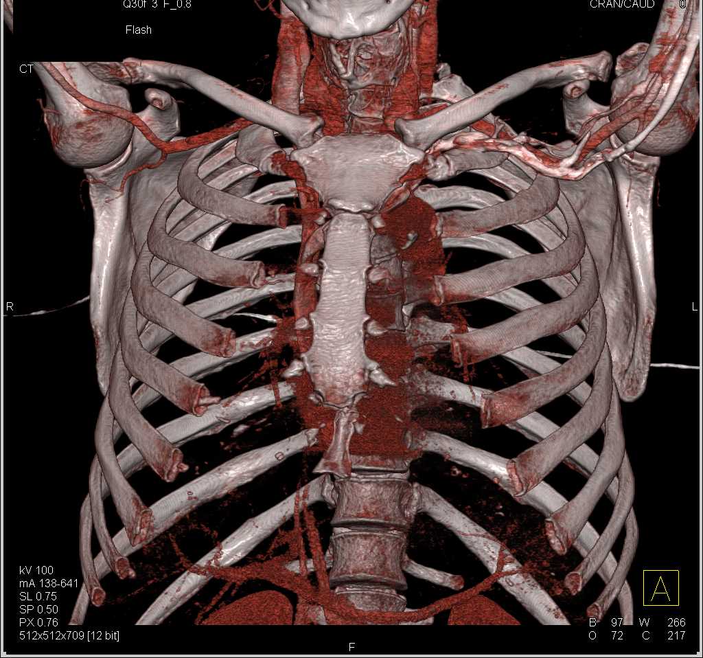 Vascular Mapping of Thoracic Syndrome on the Left Side - CTisus CT Scan