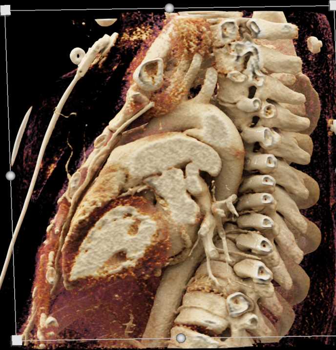 Patent Ductus Arteriosus (PDA) - CTisus CT Scan