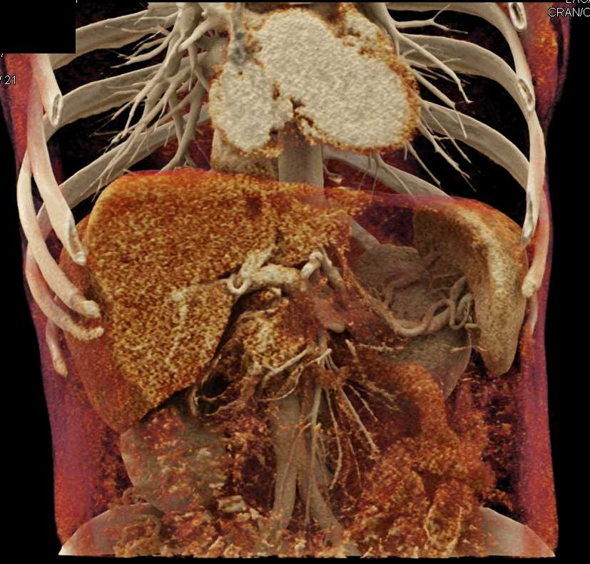 Carcinoma Tail of Pancreas with Vascular Collaterals - CTisus CT Scan