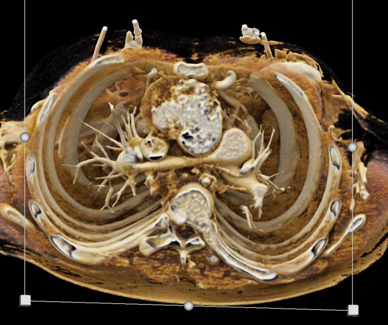 Bleed from Ascending Aorta Repair - CTisus CT Scan