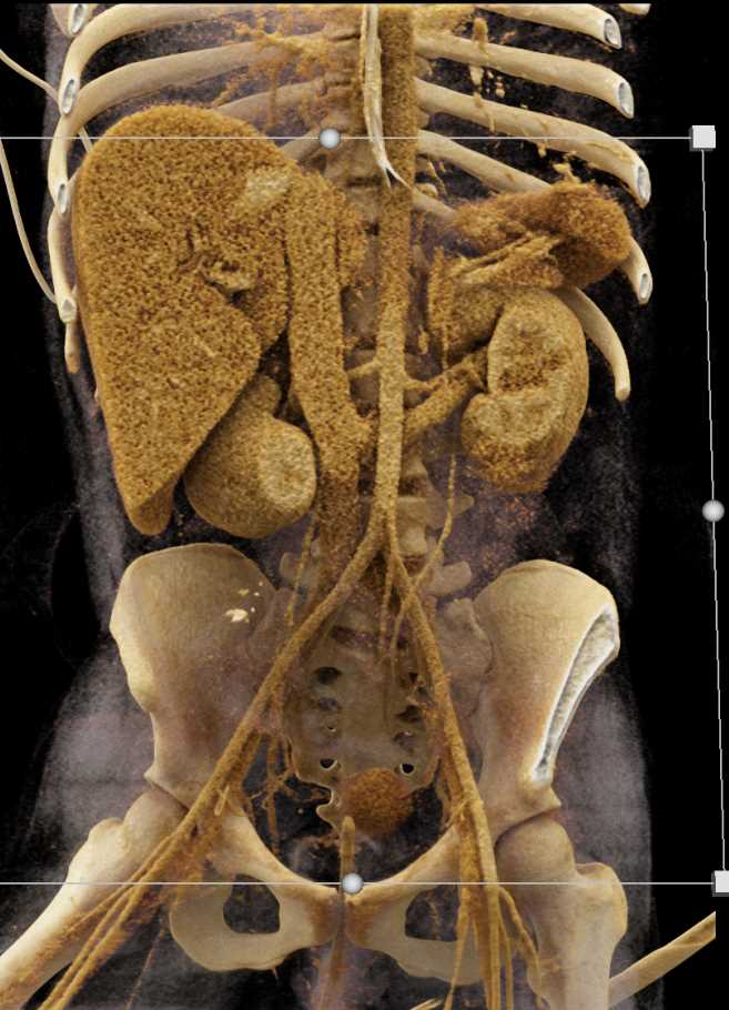 Retroaortic Left Renal Vein with Cinematic Rendering - CTisus CT Scan