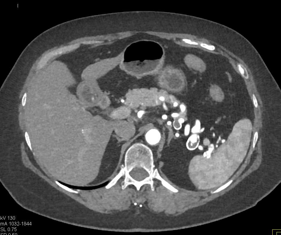 Splenic Artery Aneurysms - CTisus CT Scan