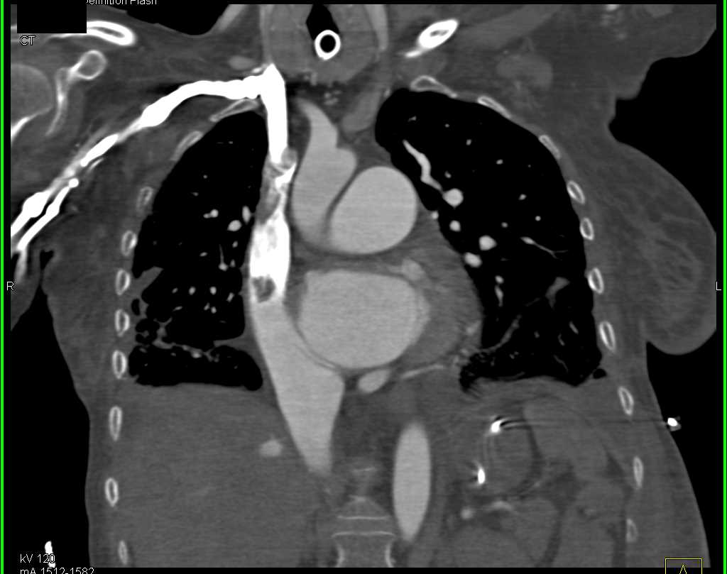 Active Bleed in the Right Pectoralis Muscle - CTisus CT Scan