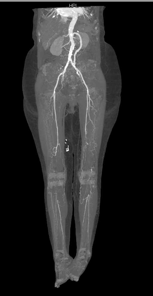 Peripheral Vascular Disease - CTisus CT Scan