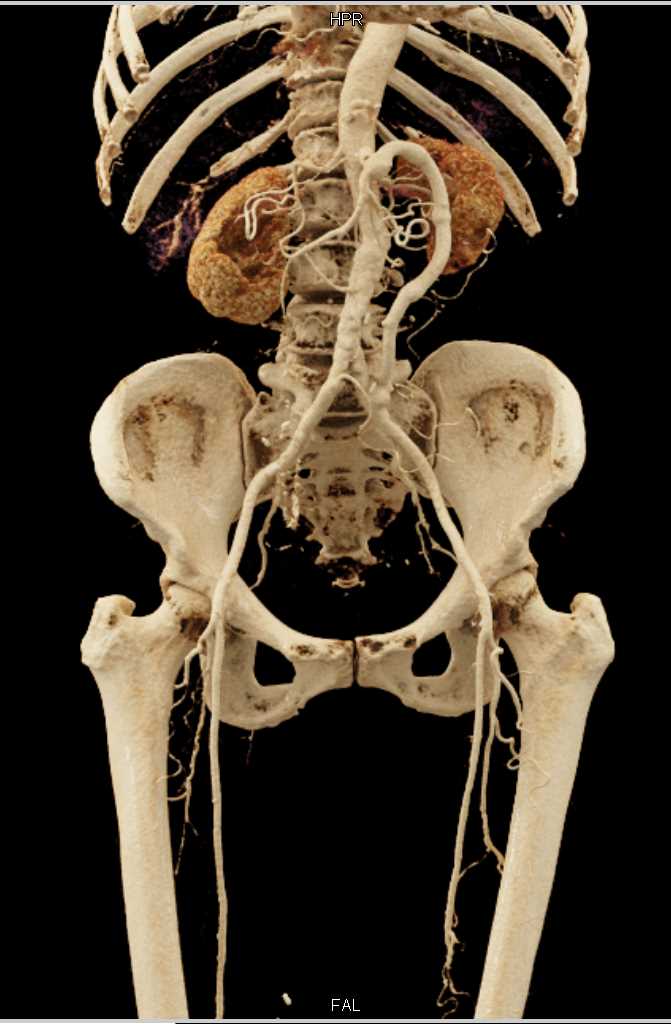 Extensive Vascular Disease with Cinematic Rendering (CR) - CTisus CT Scan