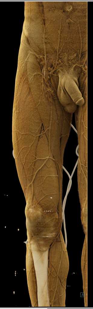 Trauma with Spasm Superficial Femoral Artery (SFA) - CTisus CT Scan