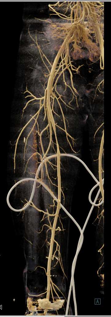 Trauma with Spasm Superficial Femoral Artery (SFA) - CTisus CT Scan