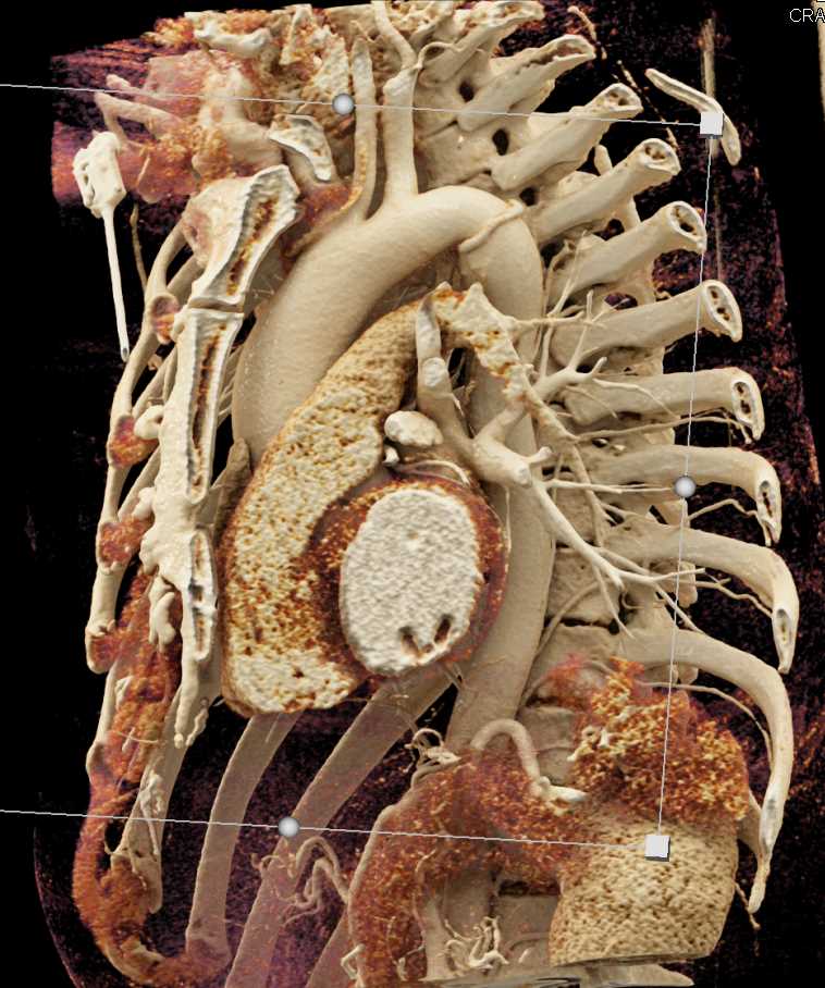 Dilated Aortic Root - CTisus CT Scan