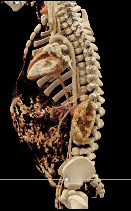 Ductus Bump but Patent Ductus Arteriosus (PDA) not Patent - CTisus CT Scan