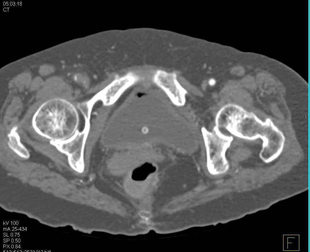 Right Superficial Femoral Artery (SFA) Occlusion with Peripheral Vascular Disease (PVD) - CTisus CT Scan