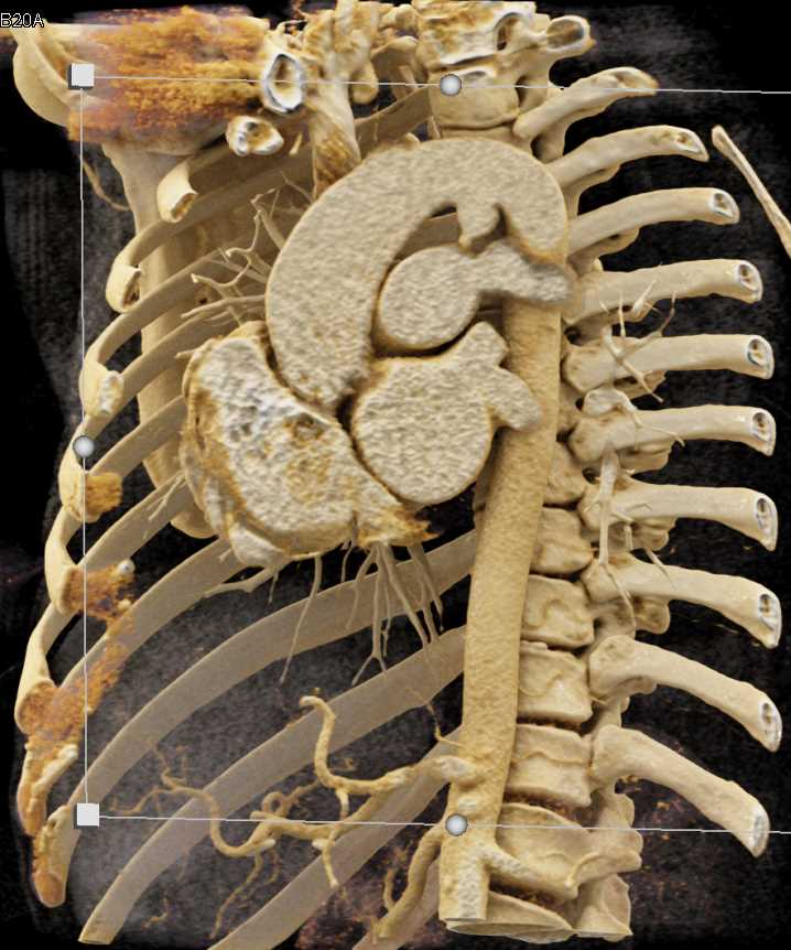 Ductus Aneurysm - CTisus CT Scan