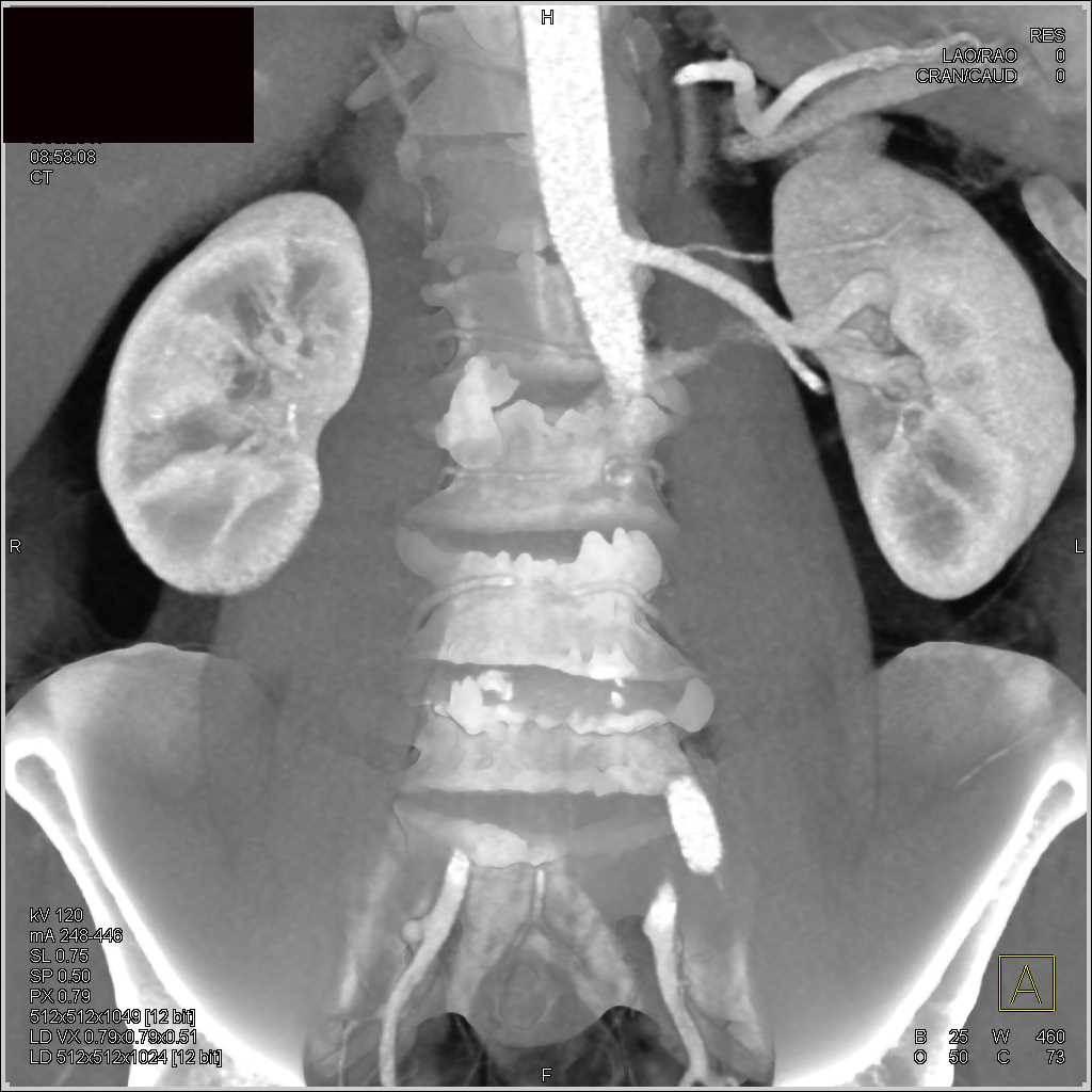 Circumaortic Left Renal Vein - CTisus CT Scan