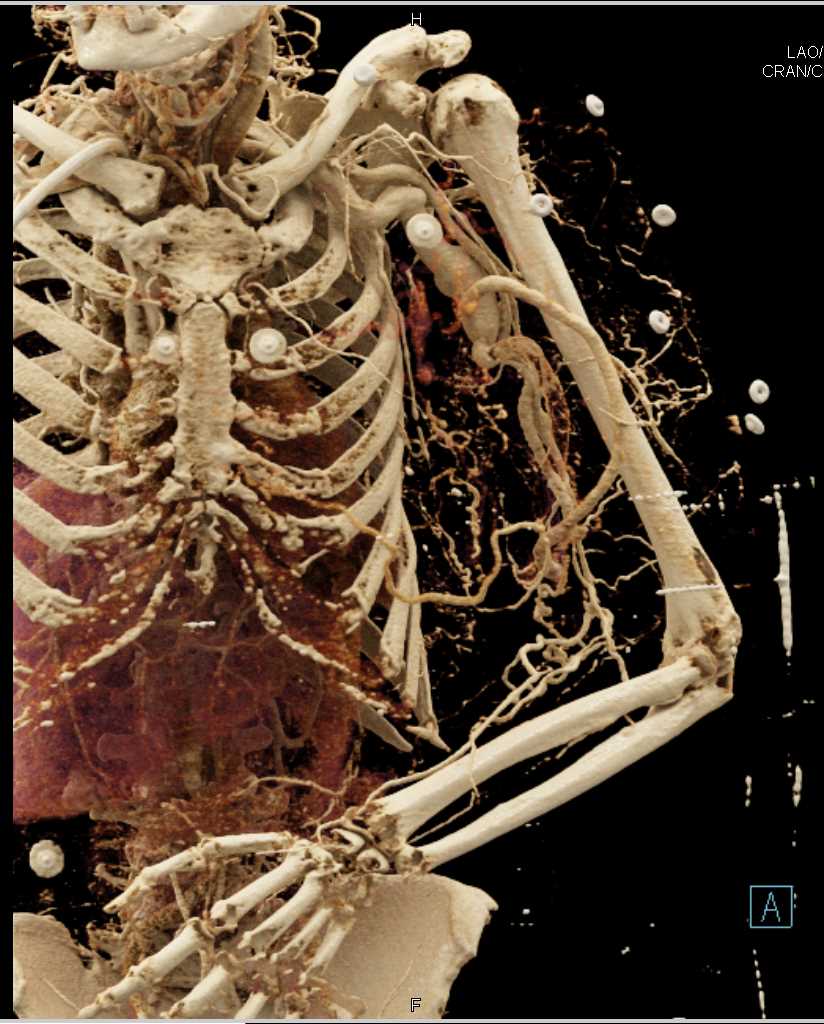 AV Fistulae Arm with Collaterals with Cinematic Rendering - CTisus CT Scan