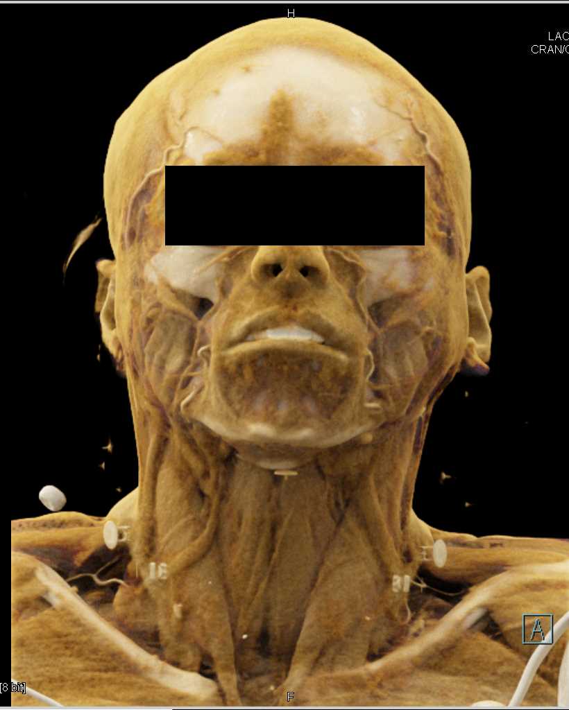 Vascular Mapping of the Carotid Arteries - CTisus CT Scan