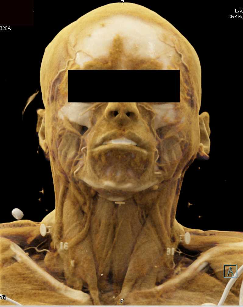 Vascular Mapping of the Carotid Arteries - CTisus CT Scan