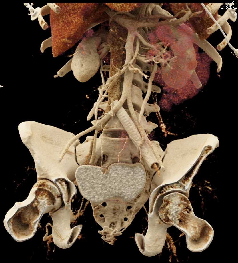 Cinematic Rendering of the Bladder and Ovarian Metastases and Stent in Left Iliac Vein - CTisus CT Scan