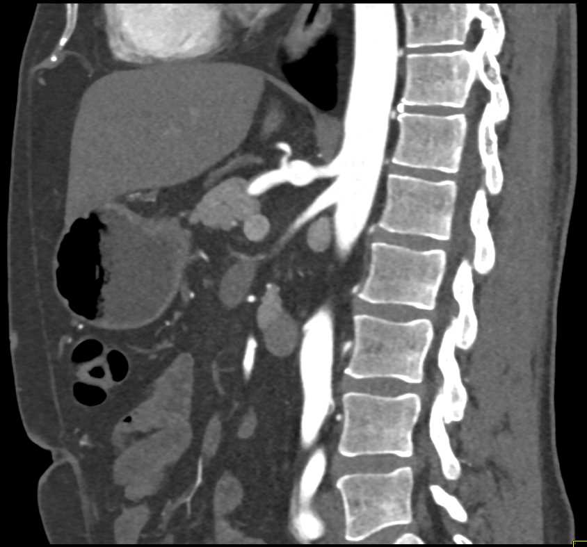 Celiac Artery Aneurysm - CTisus CT Scan
