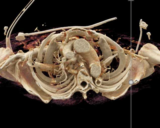 Motor Vehicle Accident (MVA) with Chest and Aortic Trauma - CTisus CT Scan