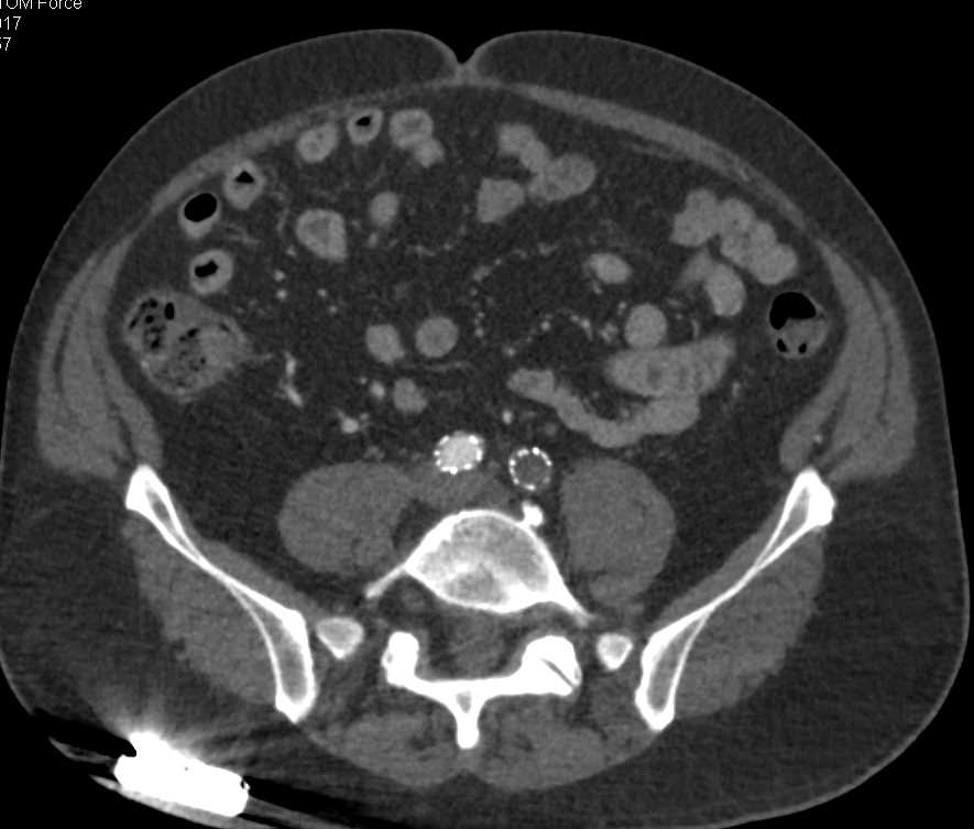 Fem-Fem Graft with Occluded Left Common Iliac Artery Stent and Peripheral Peripheral Arterial Disease (PAD) - CTisus CT Scan