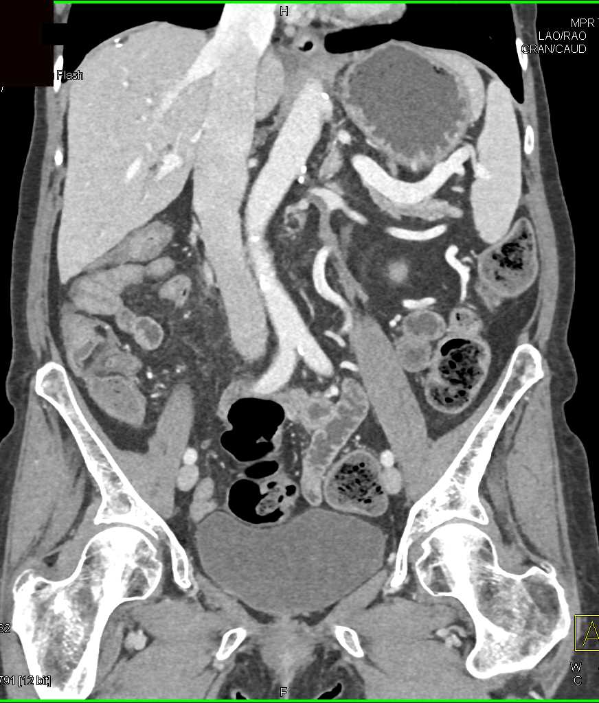 Clot in Left Renal Vein and Gonadal Vein - CTisus CT Scan
