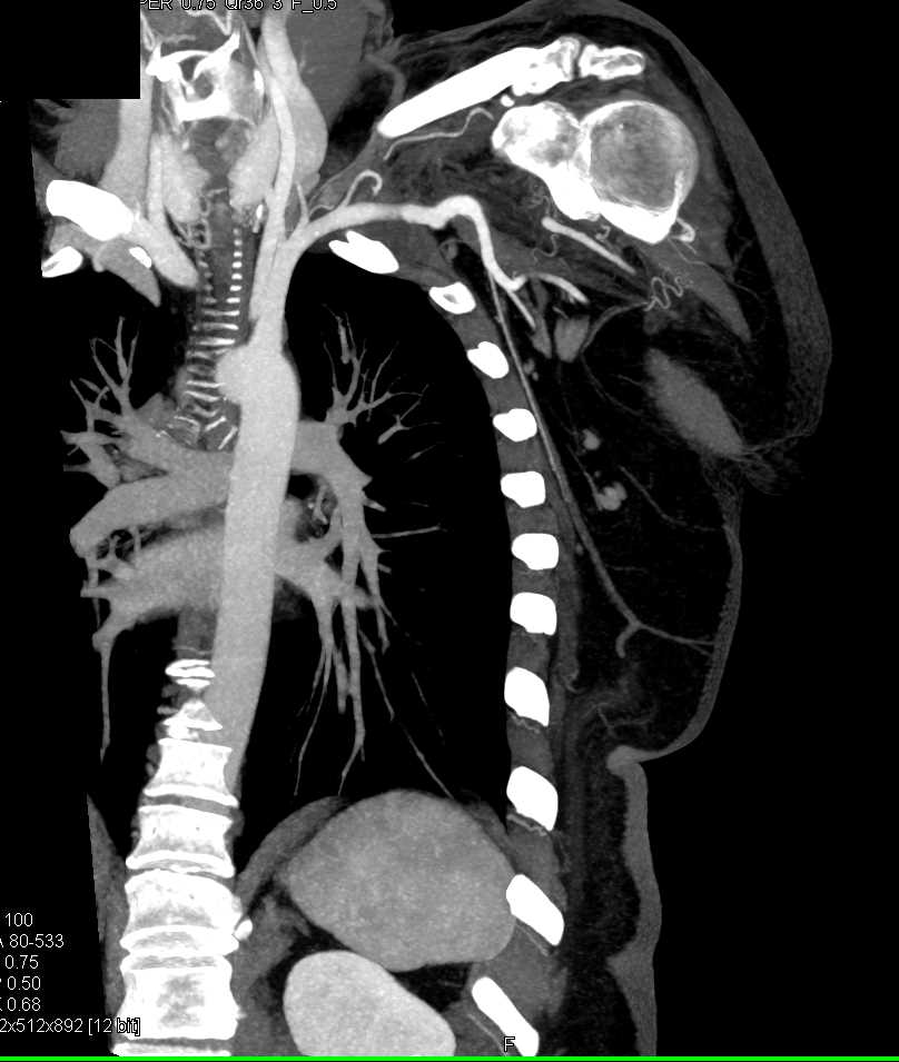 Brachial Artery Occlusion - CTisus CT Scan