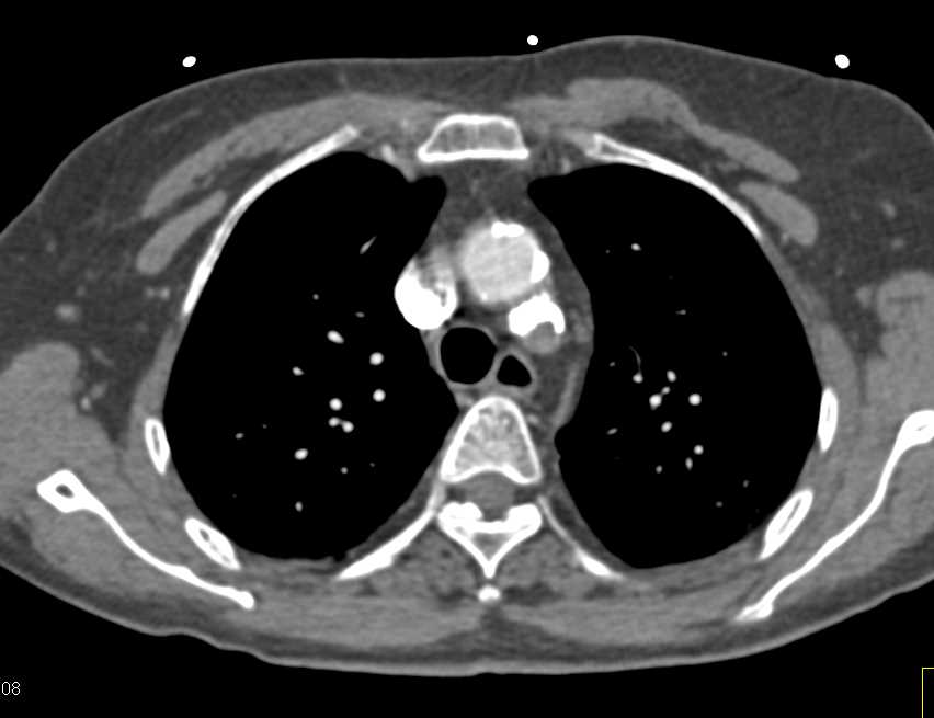 Clot in the Left Subclavian Artery - CTisus CT Scan