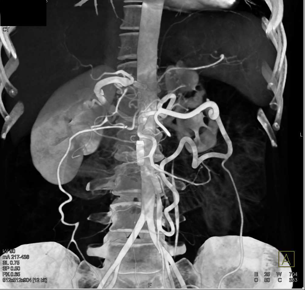 Collateral Flow due to Superior Mesenteric Artery (SMA) Occlusion - CTisus CT Scan
