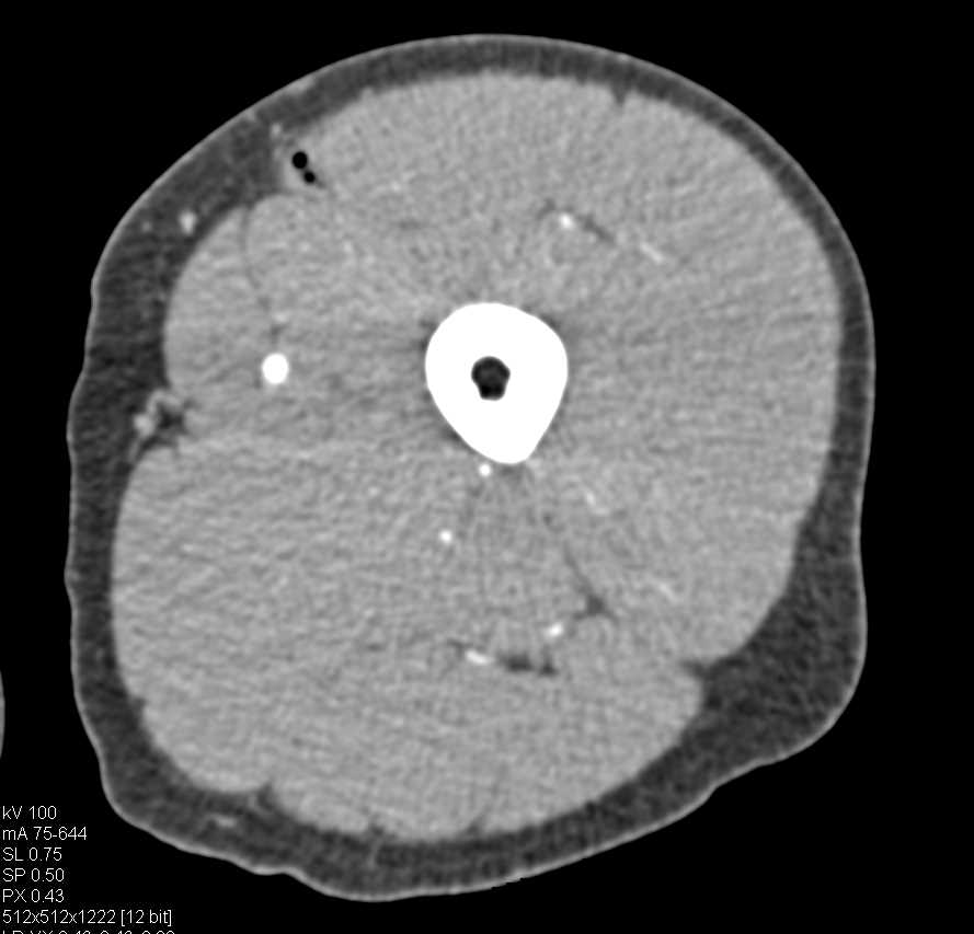 Superficial Femoral Artery (SFA) Mapping with VR and MIP - CTisus CT Scan