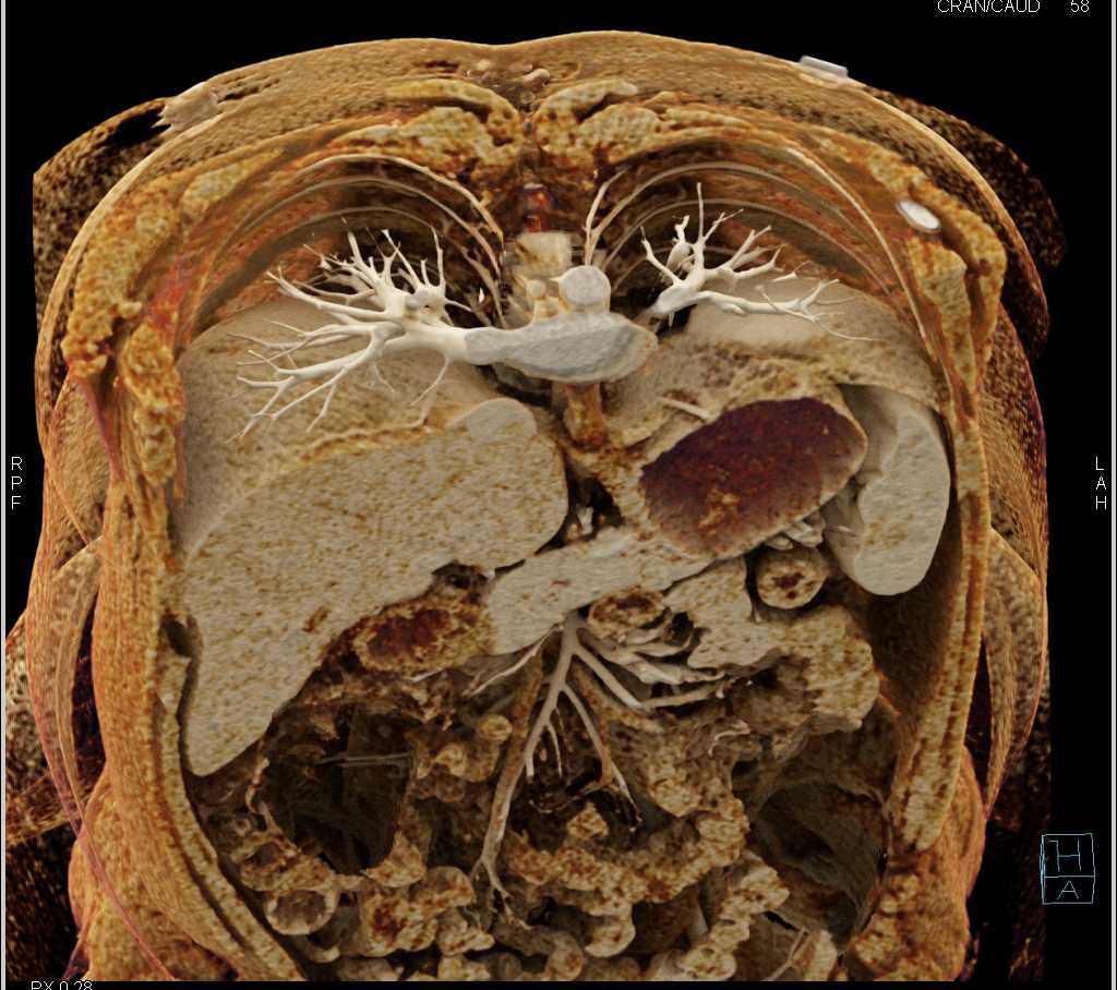 Vascular Mapping of the Aorta and Branching with Cinematic Rendering - CTisus CT Scan