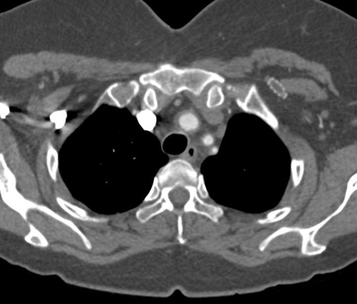 Takayasu'a Aortitis - CTisus CT Scan