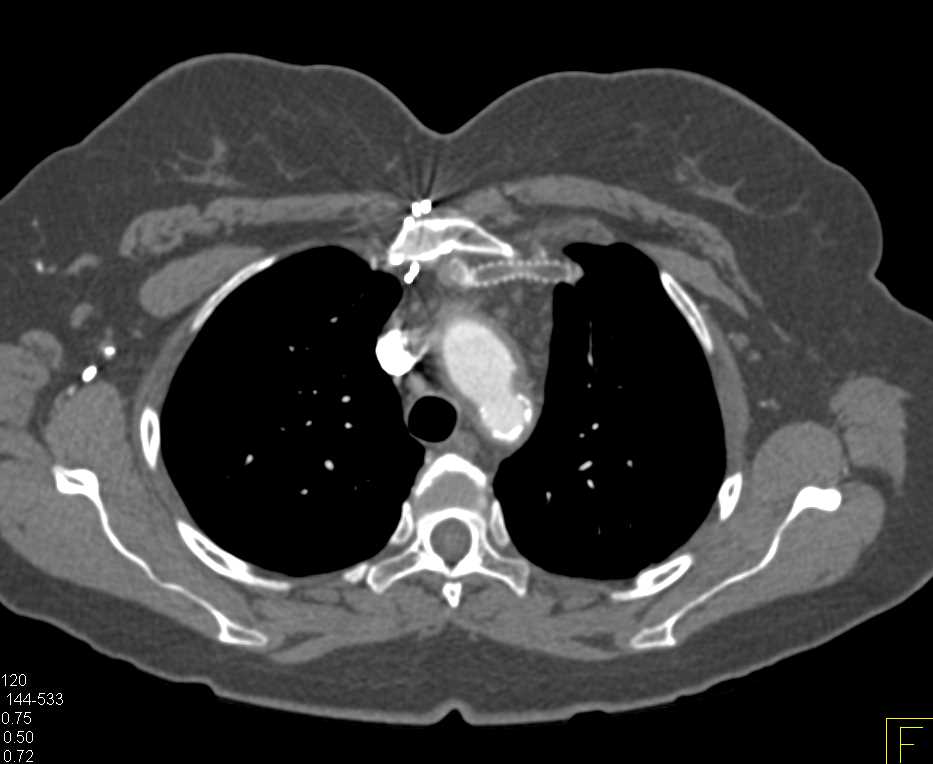 Occluded Left Graft - CTisus CT Scan