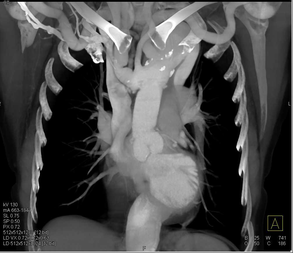 Aortic Repair with Dilated Descending Aorta - CTisus CT Scan